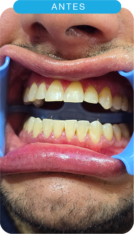 Antes del tratamiento