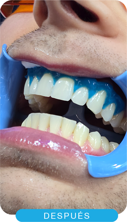 Después del tratamiento